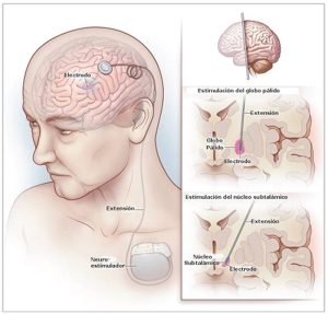 Gráfico estimulación cerebral profunda