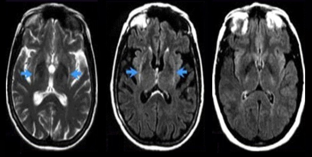 AMS Atrofia multisistémica (AMS)